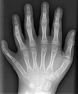 160px-Polydactyly_01_Lhand_AP.jpg
